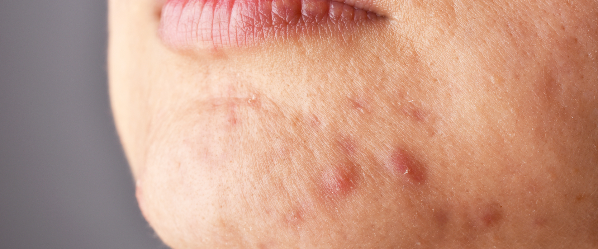 taches d'hyperpigmentation sur une femme